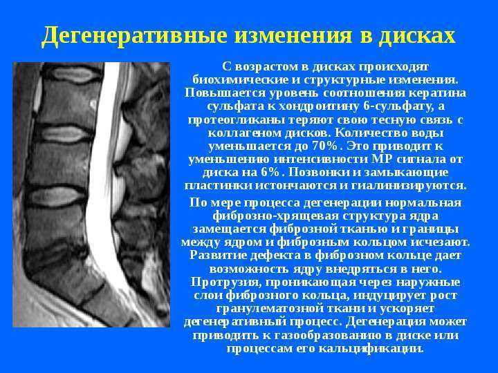 Дегенеративно-дистрофические изменения