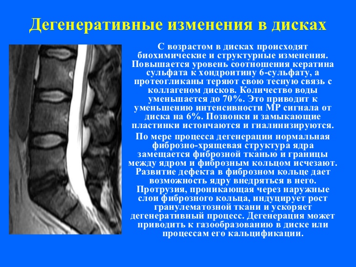 Дегенеративные изменения в дисках