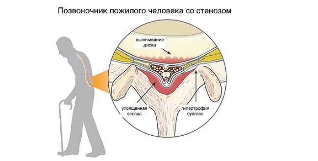 Дегенеративный стеноз - следствие естественного процесса старения позвоночника