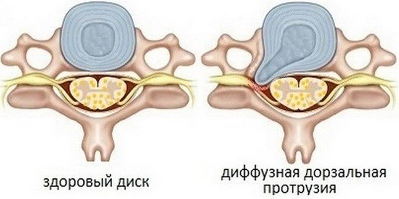 Дорзальная диффузная протрузия
