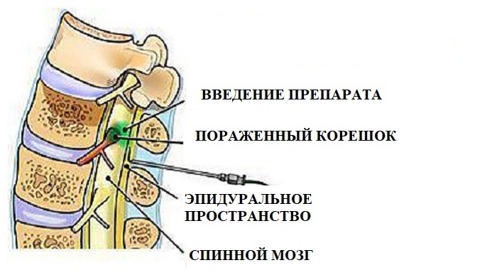 Эпидуральная блокада