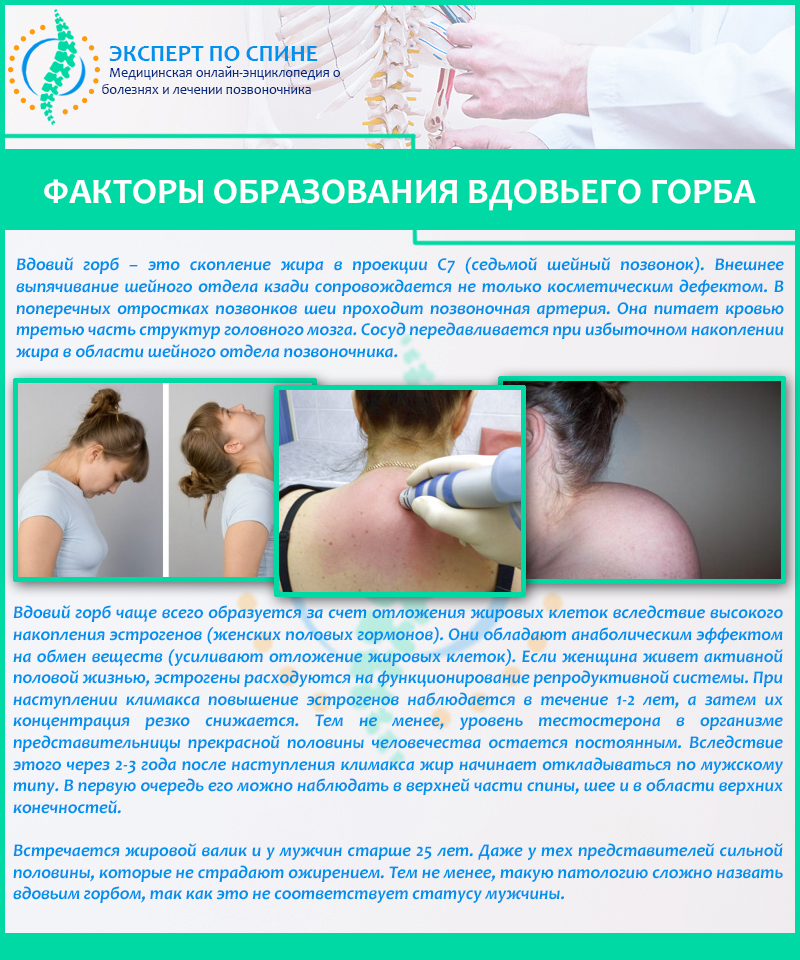 Факторы образования вдовьего горба
