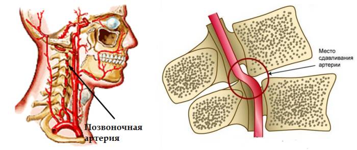 Препарат эффективен при синдроме позвоночной артерии - осложнении, часто сопровождающем остеохондроз