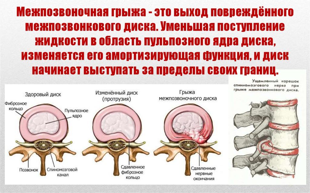 Межпозвоночная грыжа