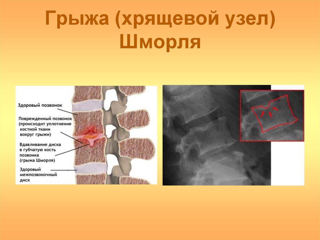 Грыжа (хрящевой узел) Шморля