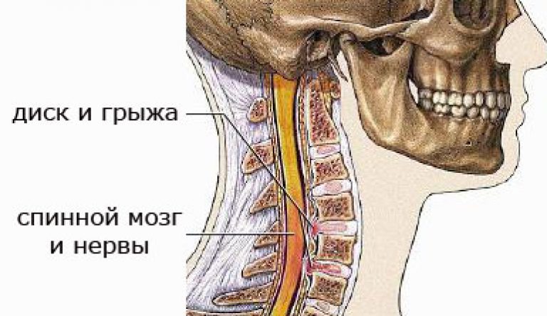 Грыжа шейного отдела позвоночника 