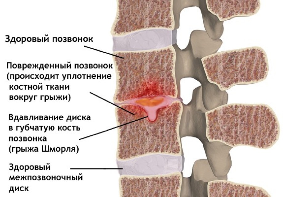 Грыжа Шморля