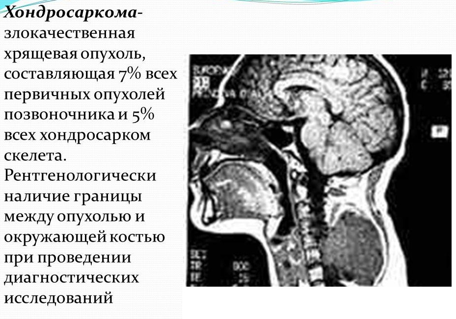 Хондросаркома