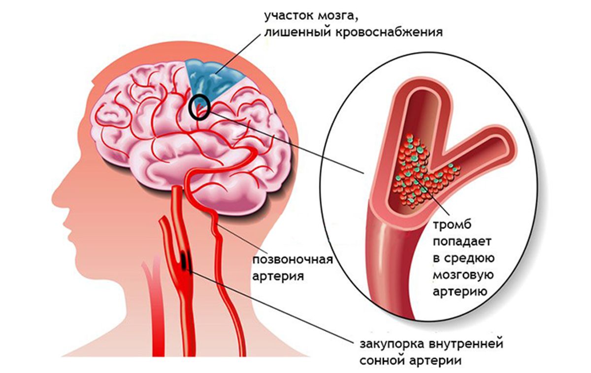Инсульт и его последствия