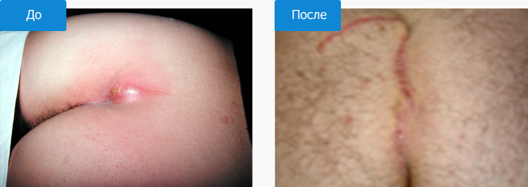 Иссечение эпителиально-копчикового хода
