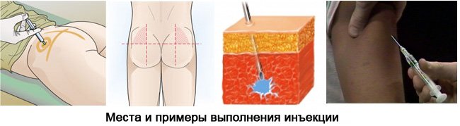 Как делать укол внутримышечно