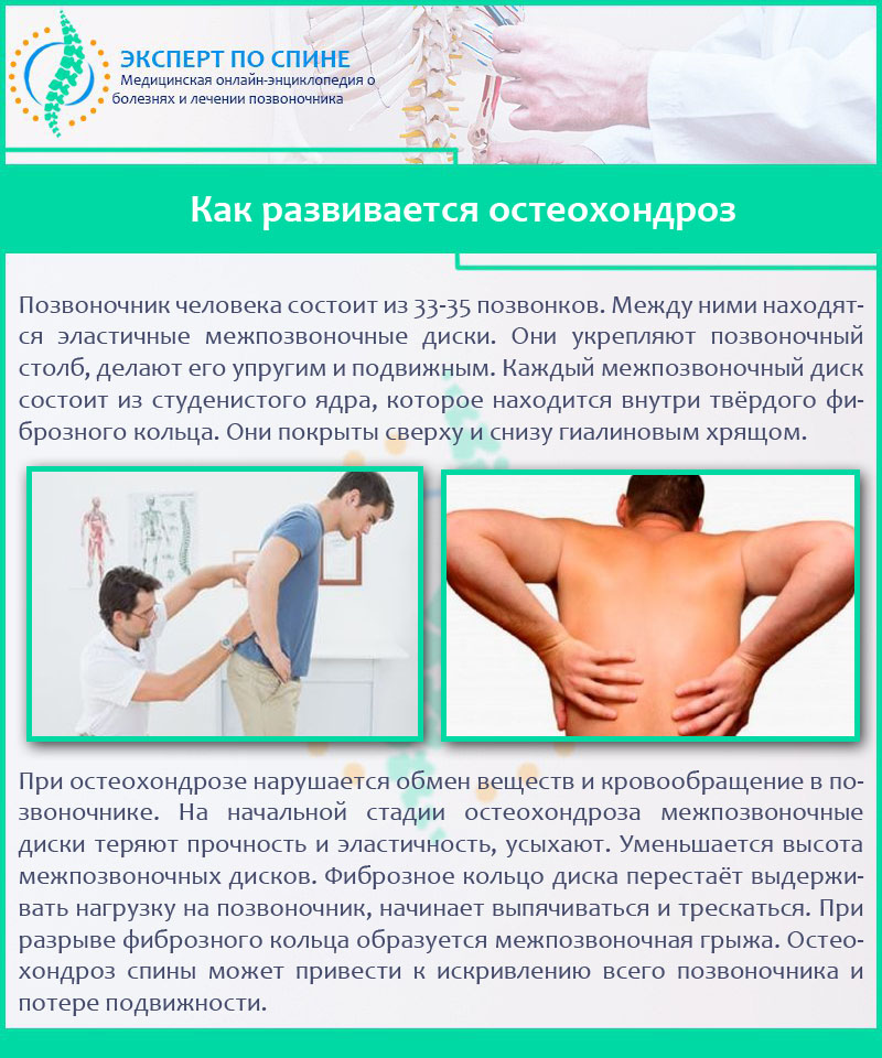 Как развивается остеохондроз