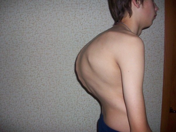 Кифоз 3 степени