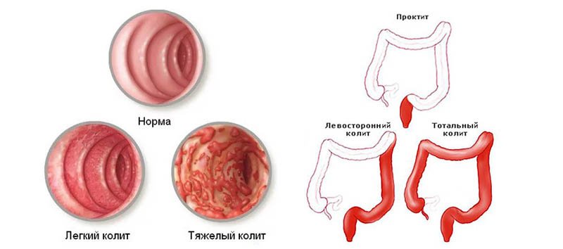 Колиты