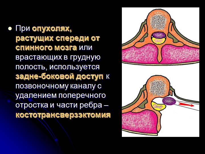 Костотрансверзэктомия