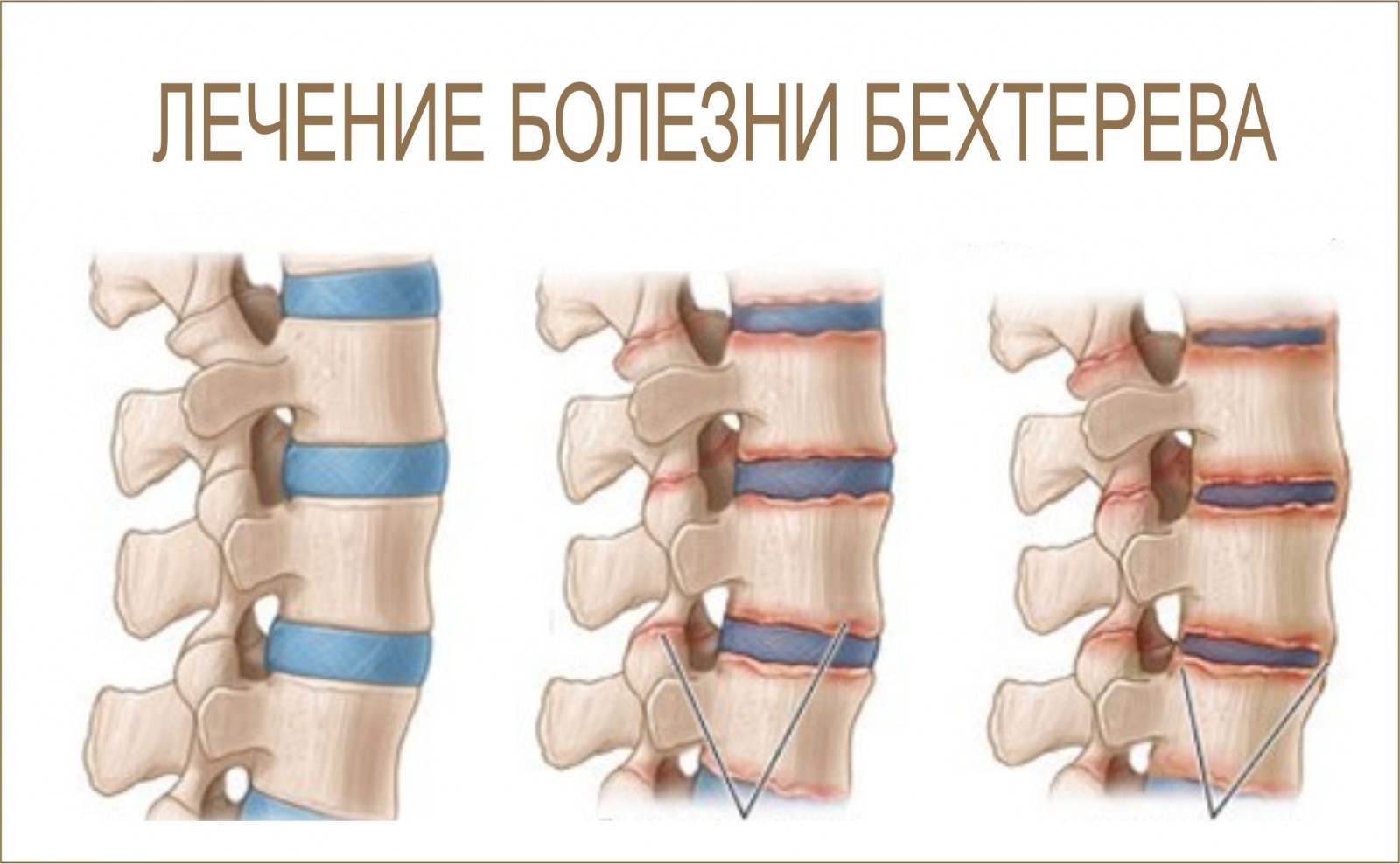 Лечение болезни Бехтерева
