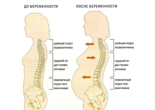 Лордоз при беременности