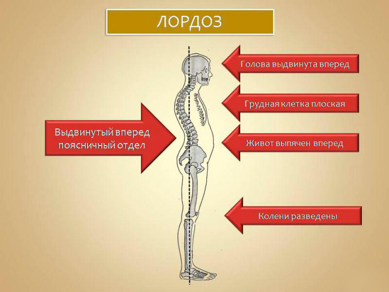 Лордоз