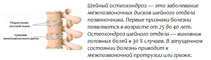 Шейный остеохондроз 