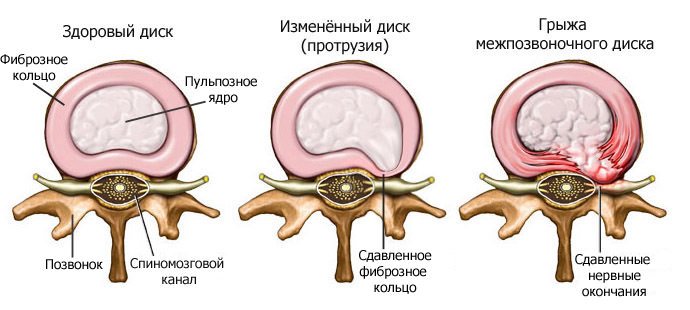 Межпозвонковая грыжа 