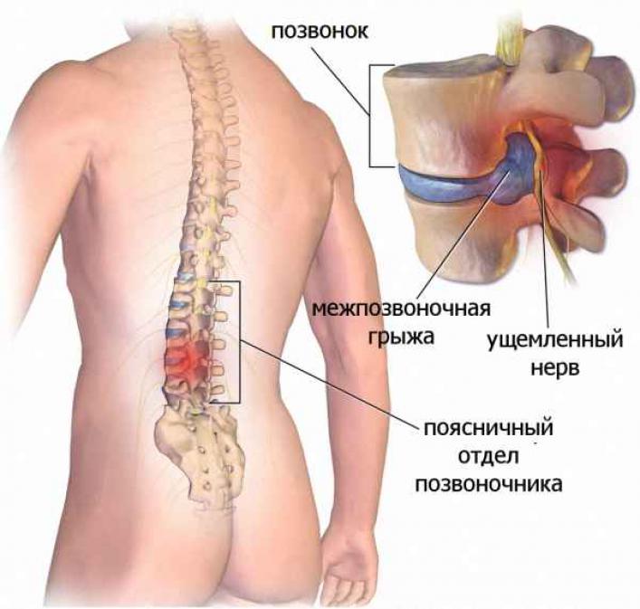 Межпозвоночная грыжа поясничного отдела