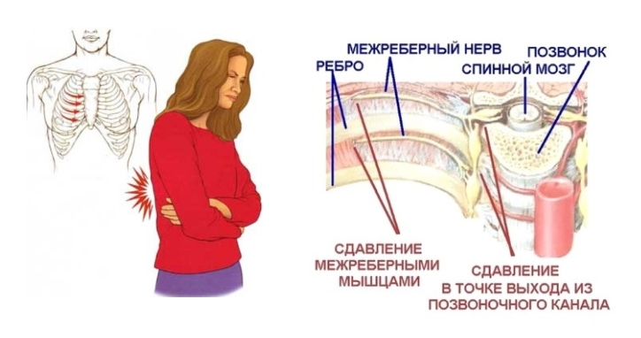Невралгия в области ребер возникает при сдавливании нервных окончаний в местах их выхода из позвоночного столба