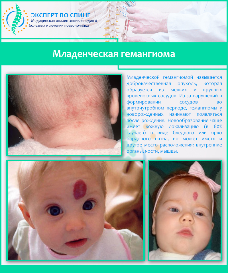 Младенческая гемангиома