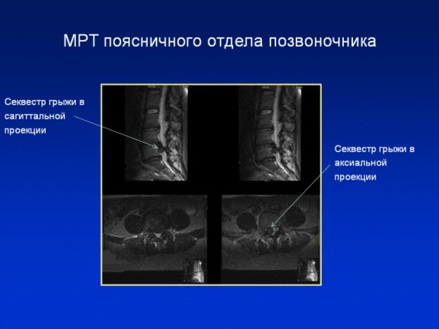 МРТ поясничного отдела позвоночника