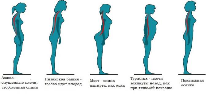 Нарушение осанки при сколиозе