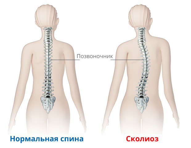 Нормальная спина и сколиоз