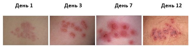Опоясывающий герпес – спорадически возникающее заболевание