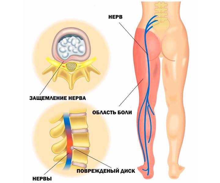 Основные причины защемления седалищного нерва