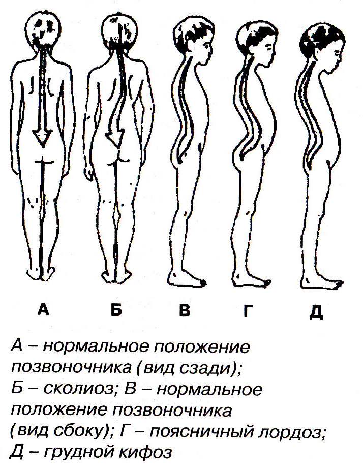 Основные типы нарушения осанки