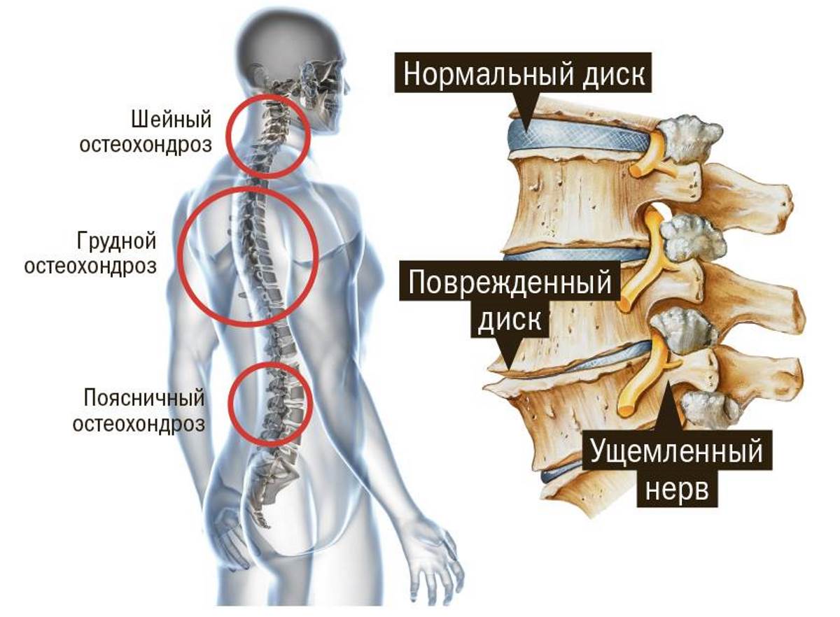 Остеохондроз