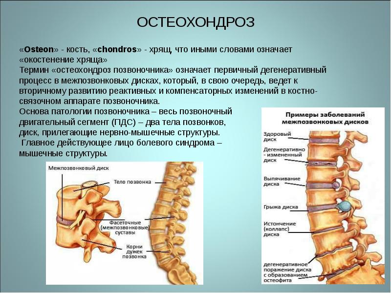 Остеохондроз