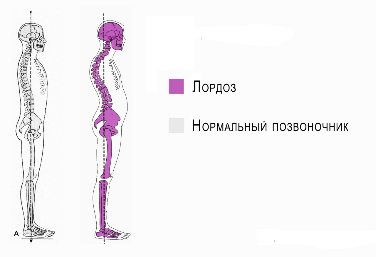 Патологический лордоз 