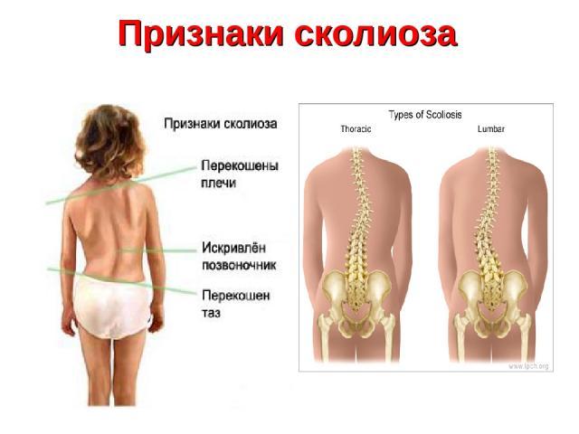 Патология выражается искривлением позвоночника
