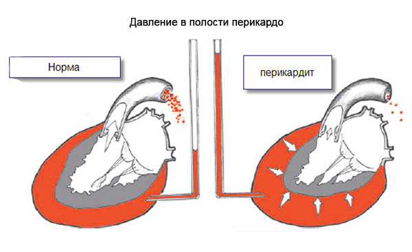 Перикардит сердца