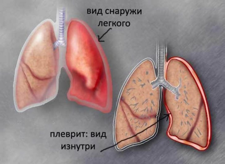 Плеврит легких