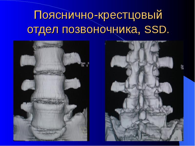 Пояснично-крестцовый отдел позвоночника
