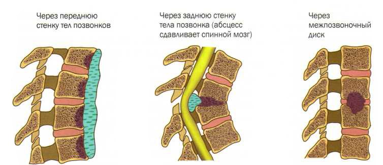 Типы поражения позвоночника при туберкулезе