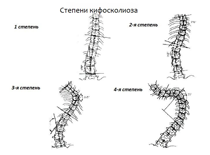 Степени искривления позвоночного столба при кифосколиозе
