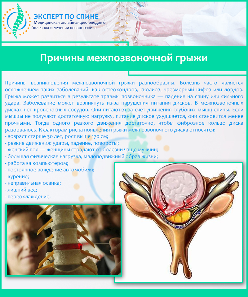 Причины межпозвоночной грыжи