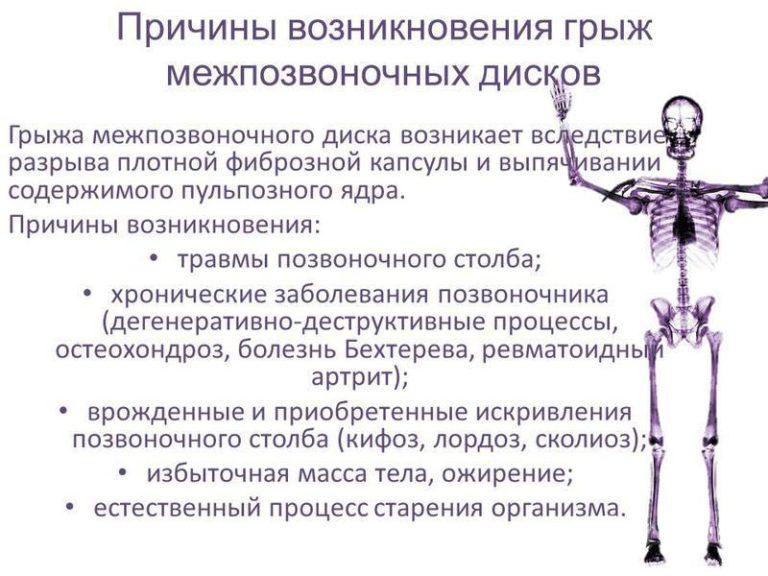 Причины возникновения грыж