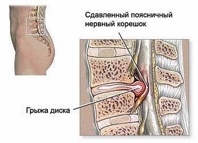 Грыжа пояснично-крестцового отдела