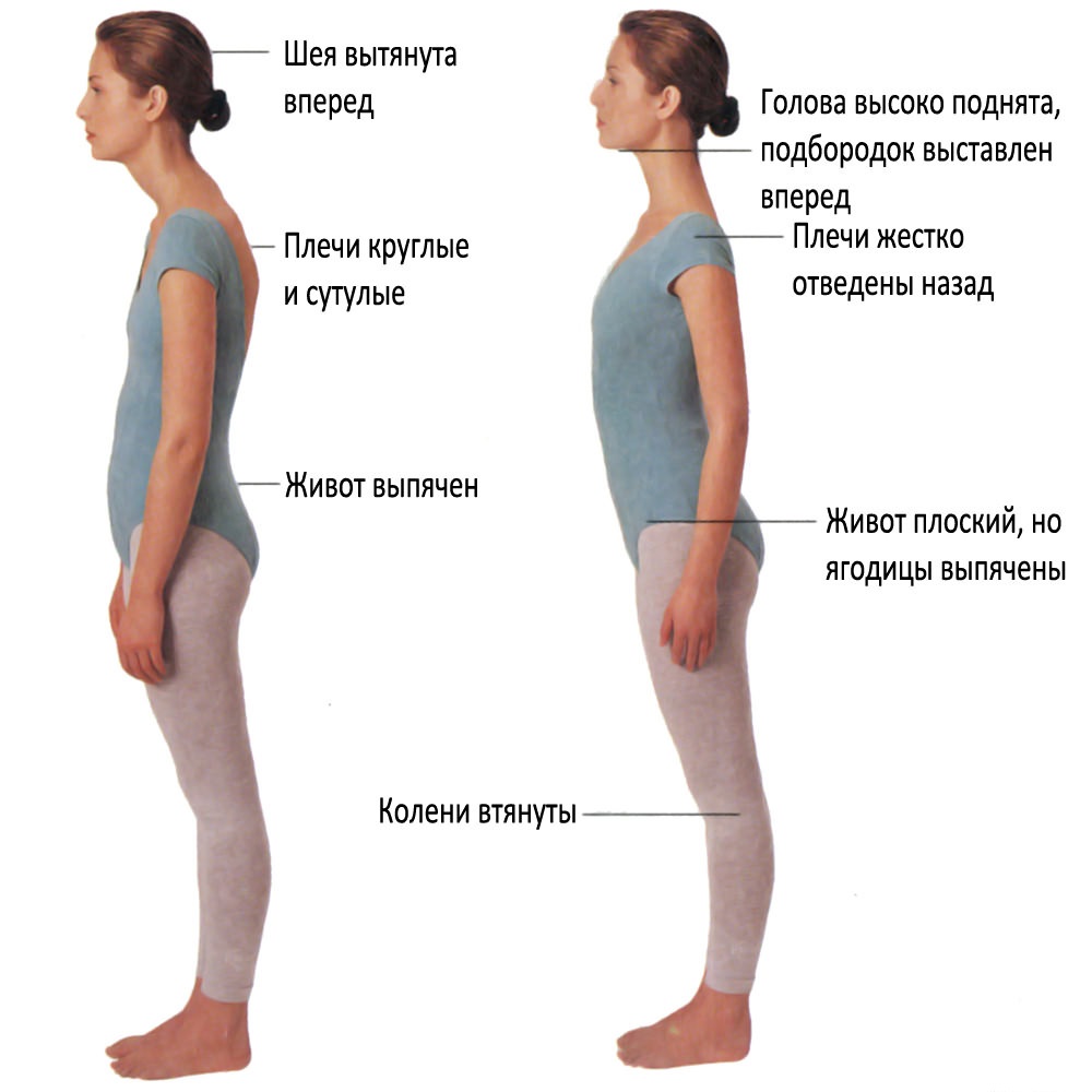 Признаки лордоза
