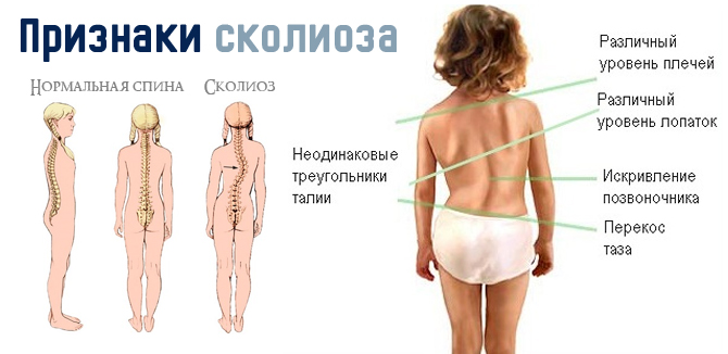 Признаки сколиоза