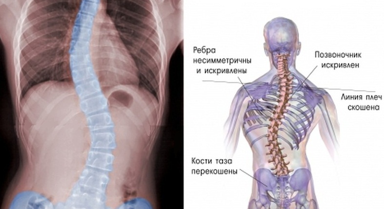 Из-за деформации позвоночник становится очень уязвимым к внешнему воздействию