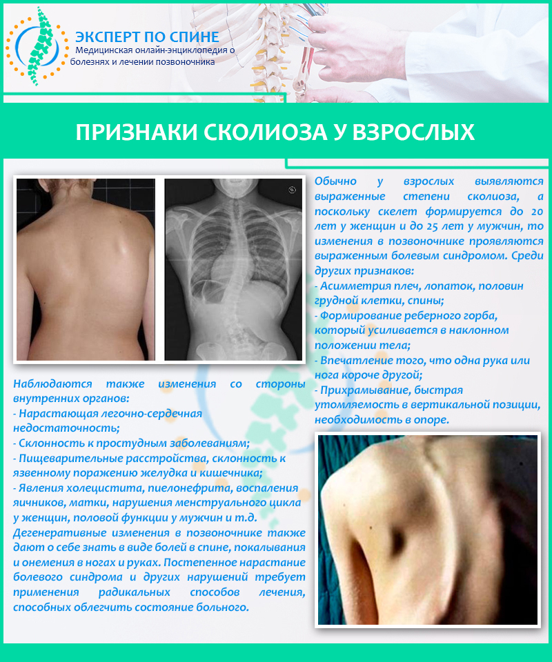 Признаки сколиоза у взрослых