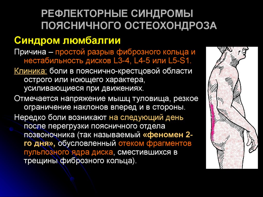 Рефлекторные синдромы поясничного остеохондроза